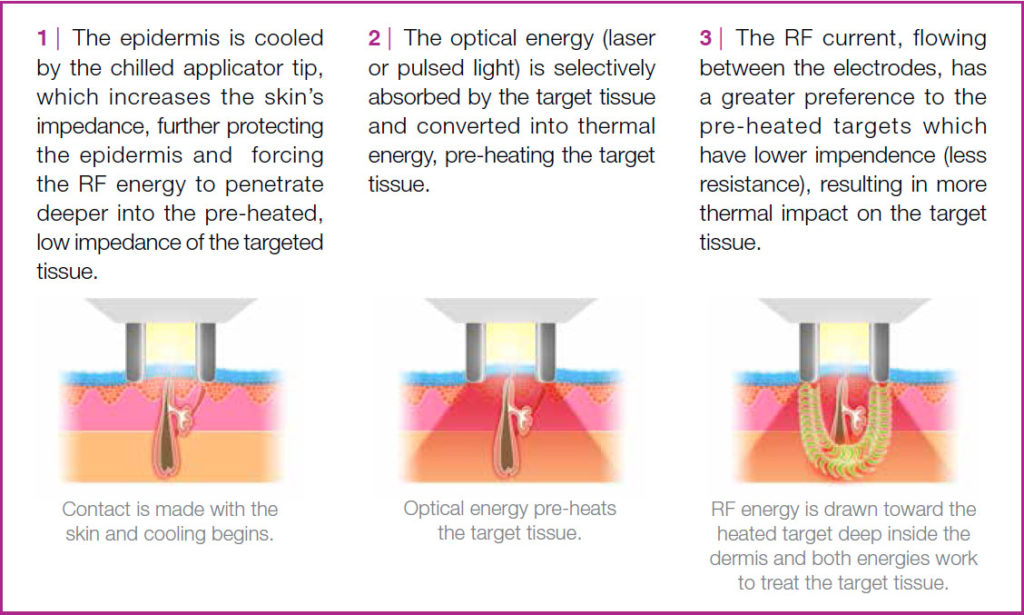 Syneron elos | elos Technology - How It Works in Medical ...