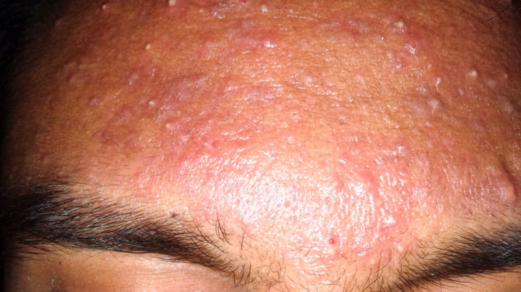 acne laser treatments